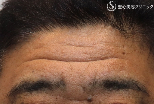 【50代男性・額も自然に若返り】プレミアムPRP皮膚再生療法（6ヶ月後） Before 