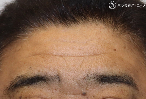 【50代男性・額も自然に若返り】プレミアムPRP皮膚再生療法（6ヶ月後） After 
