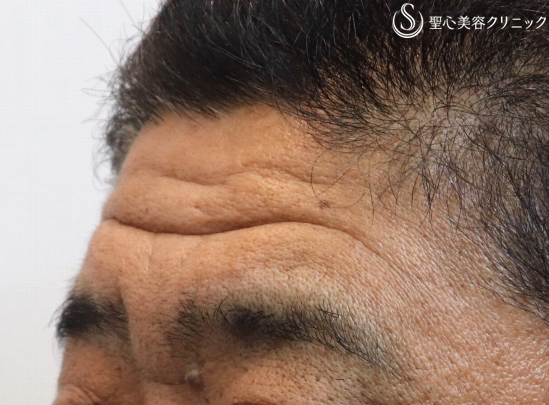 【50代男性・額も自然に若返り】プレミアムPRP皮膚再生療法（6ヶ月後） Before 