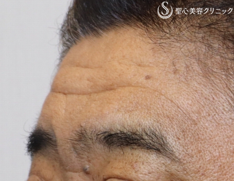 【50代男性・額も自然に若返り】プレミアムPRP皮膚再生療法（6ヶ月後） After 