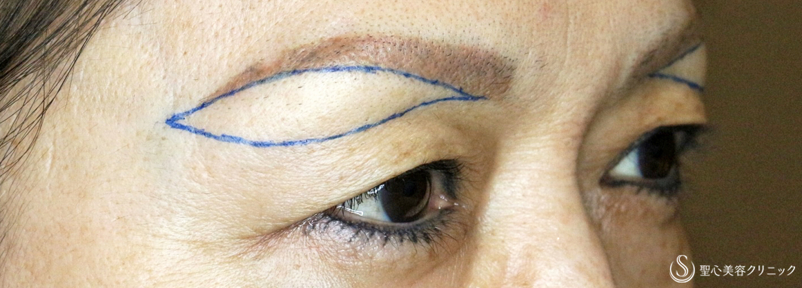【60代女性・20年前の目元に戻してみました】眉下リフト+α 2回目（1年後） Before 