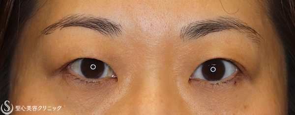 【40代女性・目元のアンチエイジング】眉下切開術（眉下リフト）（１ヶ月後） Before 