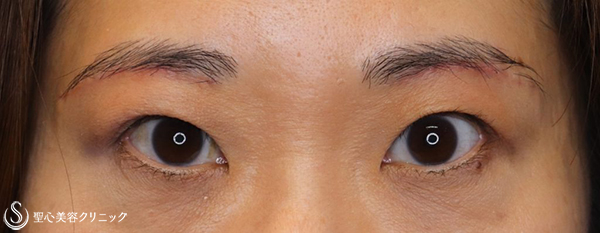 【40代女性・目元のアンチエイジング】眉下切開術（眉下リフト）（１ヶ月後） After 