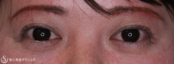 【30代女性・まぶたをスッキリさせる】眉下切開法（眉下リフト）（１ヶ月後） After 