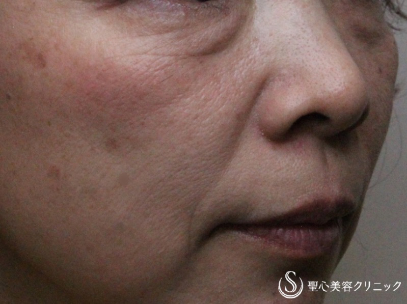 【40代女性・目の下、ほうれい線】プレミアムPRP皮膚再生療法（1年後） Before 