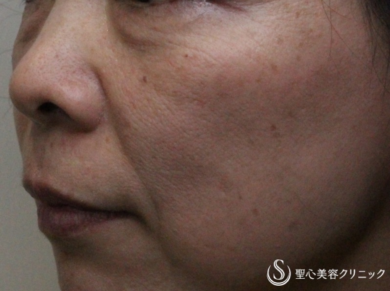 【40代女性・目の下、ほうれい線】プレミアムPRP皮膚再生療法（1年後） Before 