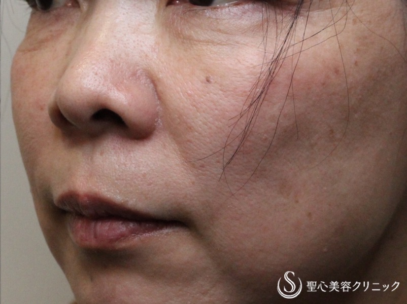 【40代女性・目の下、ほうれい線】プレミアムPRP皮膚再生療法（1年後） After 