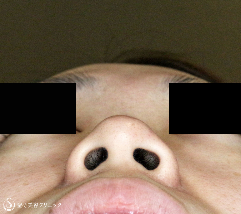 【20代女性・鼻の存在感を消す】小鼻縮小術+α法「Ver.3」（1年8ヶ月後） After 