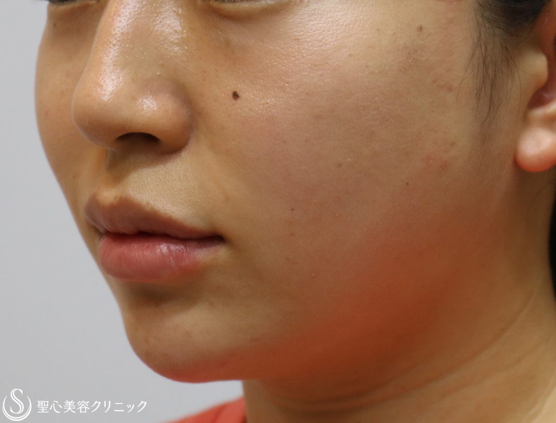 【30代女性・ダブル効果で頬のたるみを改善】アンカーマックスとドクターハイフ（ウルトラセルQプラス）（施術翌日） Before 