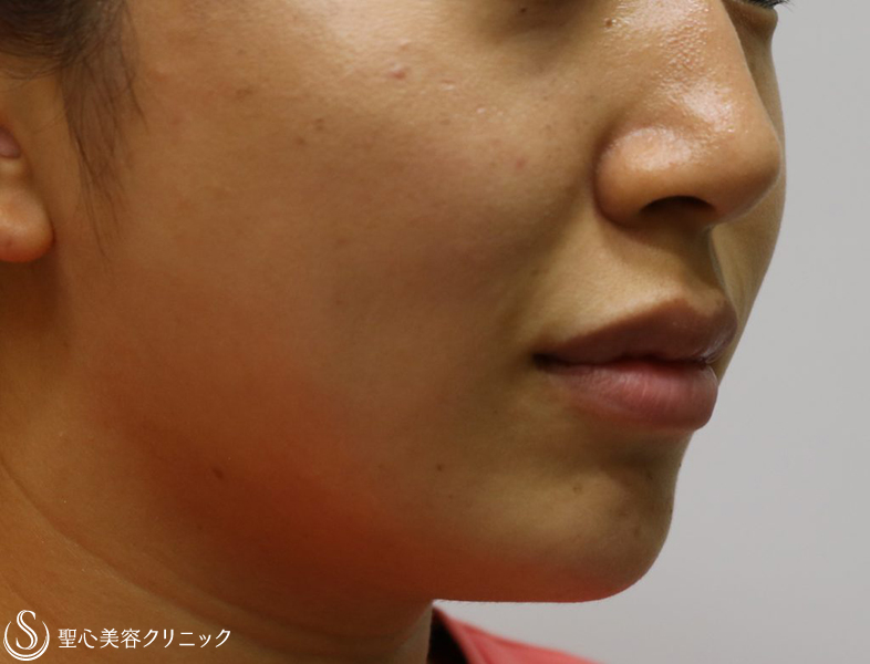 【30代女性・ダブル効果で頬のたるみを改善】アンカーマックスとドクターハイフ（ウルトラセルQプラス）（施術翌日） Before 
