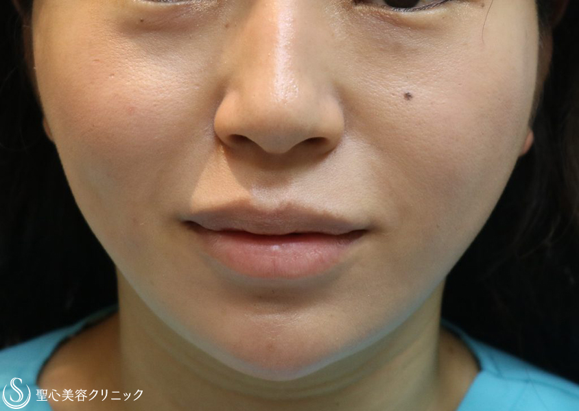 【30代女性・ダブル効果で頬のたるみを改善】アンカーマックスとドクターハイフ（ウルトラセルQプラス）（施術翌日） After 