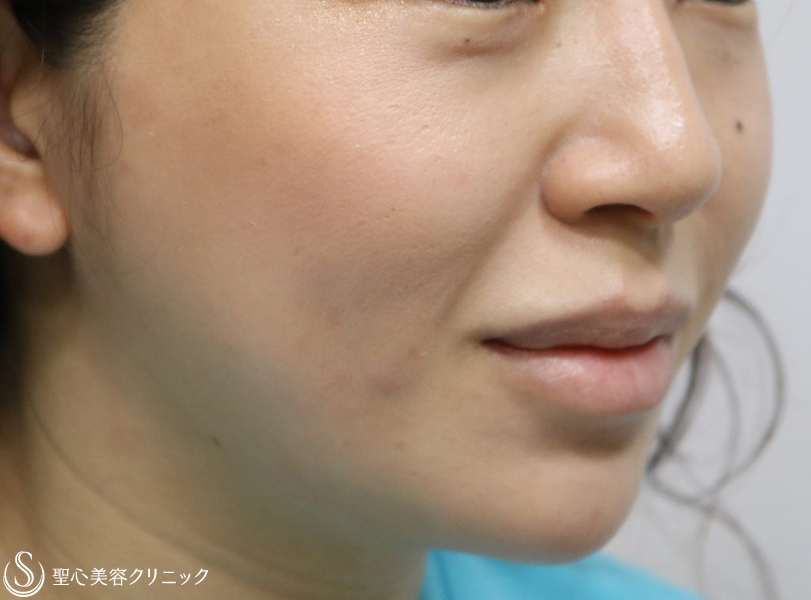 【30代女性・ダブル効果で頬のたるみを改善】アンカーマックスとドクターハイフ（ウルトラセルQプラス）（施術翌日） After 