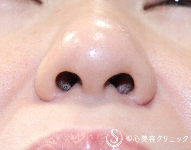 【40代女性・鼻の穴を目立たなく】小鼻縮小（7ヶ月後） After 