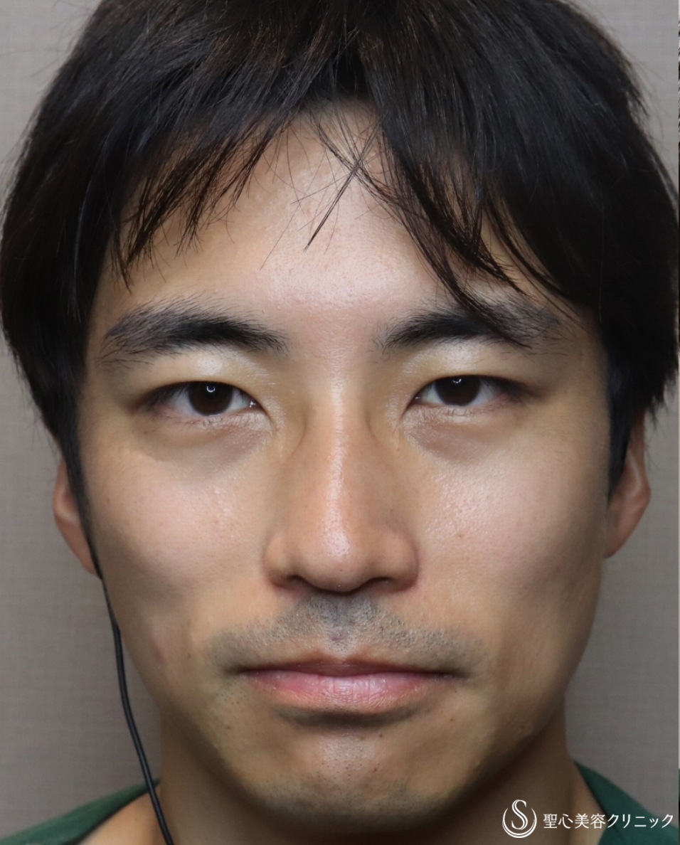 30代男性 目の上とフェイスラインをスッキリ 眉下切開 ウルトラセルq 施術直後と2ヶ月後 症例写真 美容整形 美容外科なら聖心美容クリニック 30代男性 目の上とフェイスラインをスッキリ 眉下切開 ウルトラセルq 施術直後と2ヶ月後 症例写真 美容整形 美容外科なら聖心美容クリニック