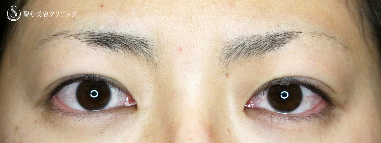 【20代女性・美容外科で行う眼瞼下垂の治療】切らない眼瞼下垂+α法（3年8ヶ月後） Before 