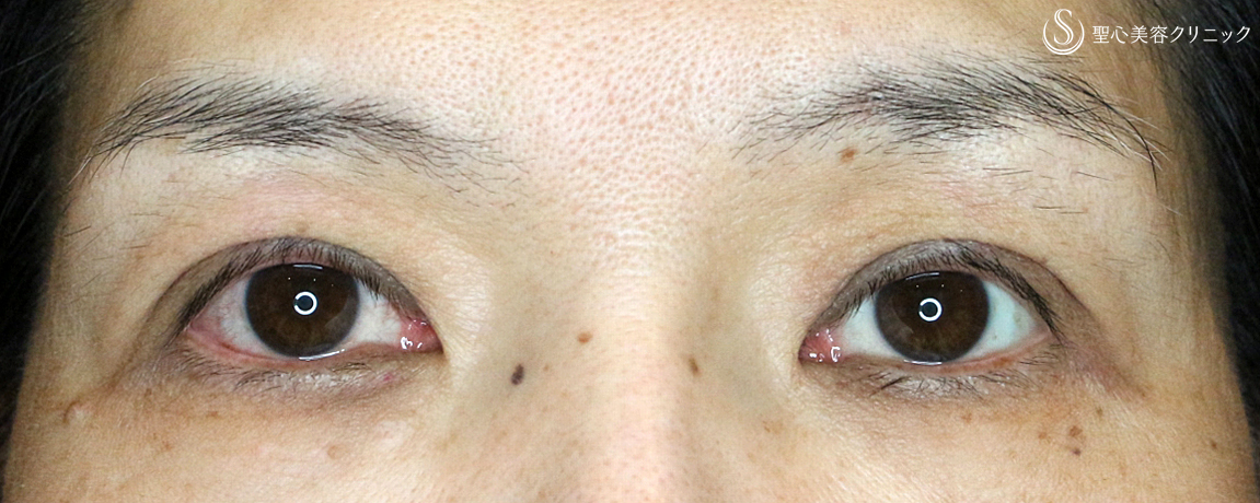 【50代女性・くぼみ目の改善効果も】「切らない眼瞼下垂+α法」単独（7年後） Before 