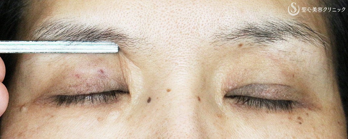 【50代女性・くぼみ目の改善効果も】「切らない眼瞼下垂+α法」単独（7年後） Before 
