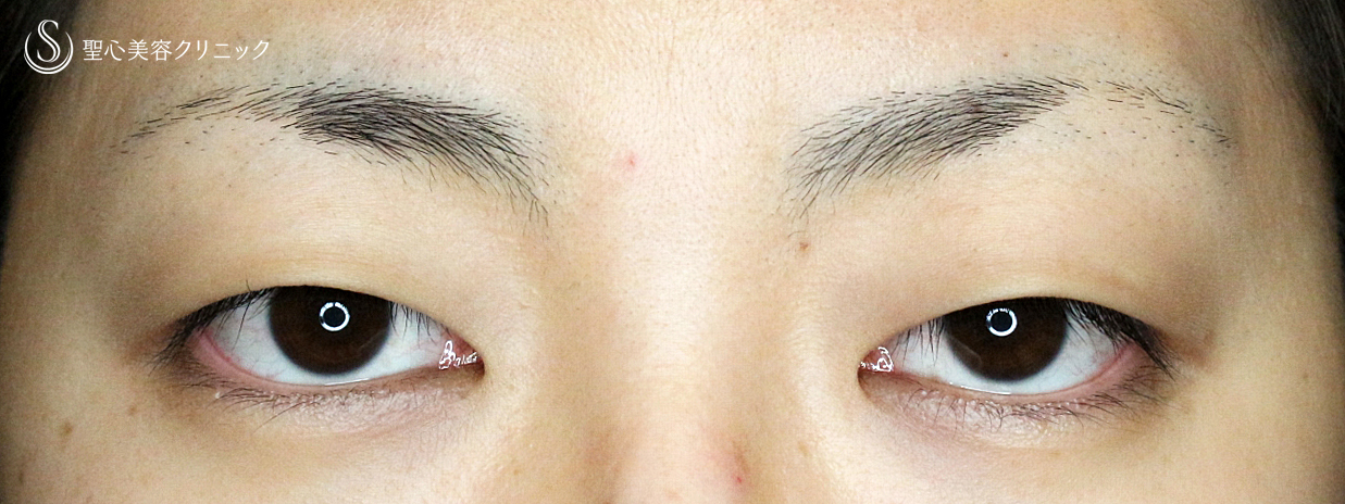 【20代女性・美容外科で行う眼瞼下垂の治療】切らない眼瞼下垂+α法（3年8ヶ月後） Before 