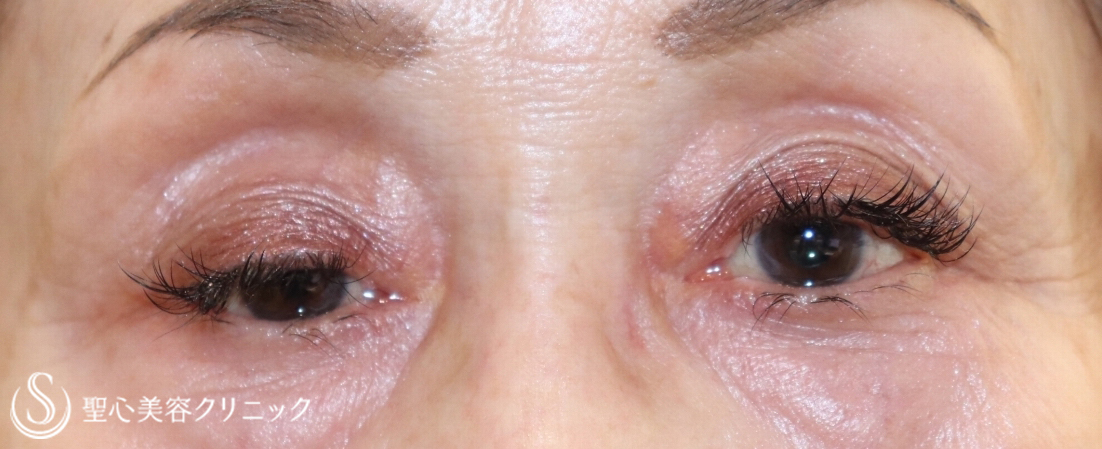 【70代女性・目の開きを改善】切らない眼瞼下垂手術（1ヶ月後） Before 