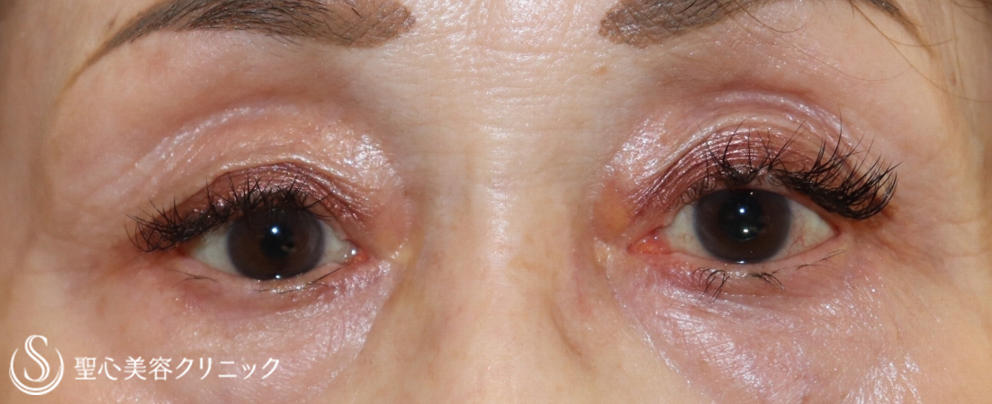 【70代女性・目の開きを改善】切らない眼瞼下垂手術（1ヶ月後） After 