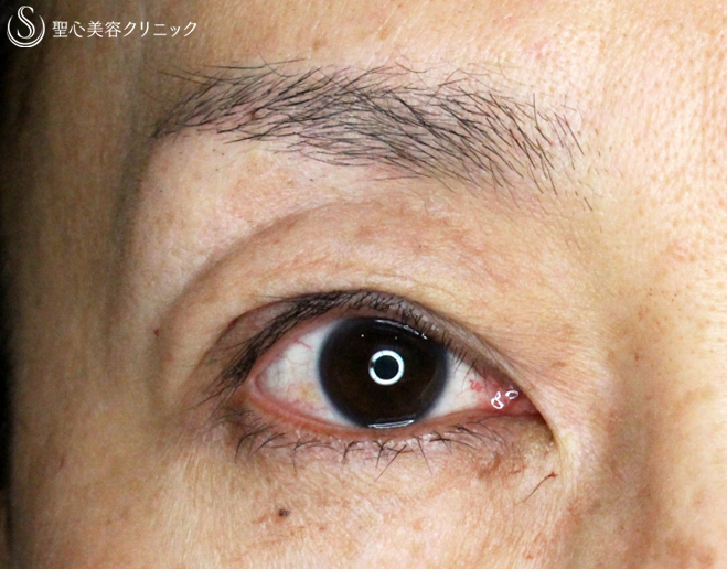 【40代女性・ハードコンタクトレンズ眼瞼下垂の長期経過】切らない眼瞼下垂+α法（9年後） After 