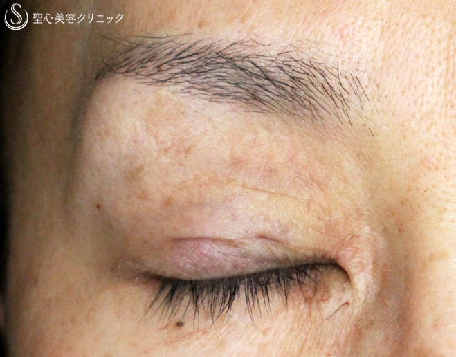 【40代女性・ハードコンタクトレンズ眼瞼下垂の長期経過】切らない眼瞼下垂+α法（9年後） After 