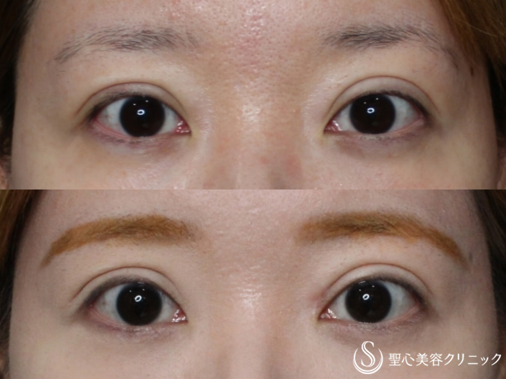 【30代女性・左右差をなくして希望の二重ラインに】目の上のたるみ取り、目頭切開（5ヶ月後、1ヶ月後） After 