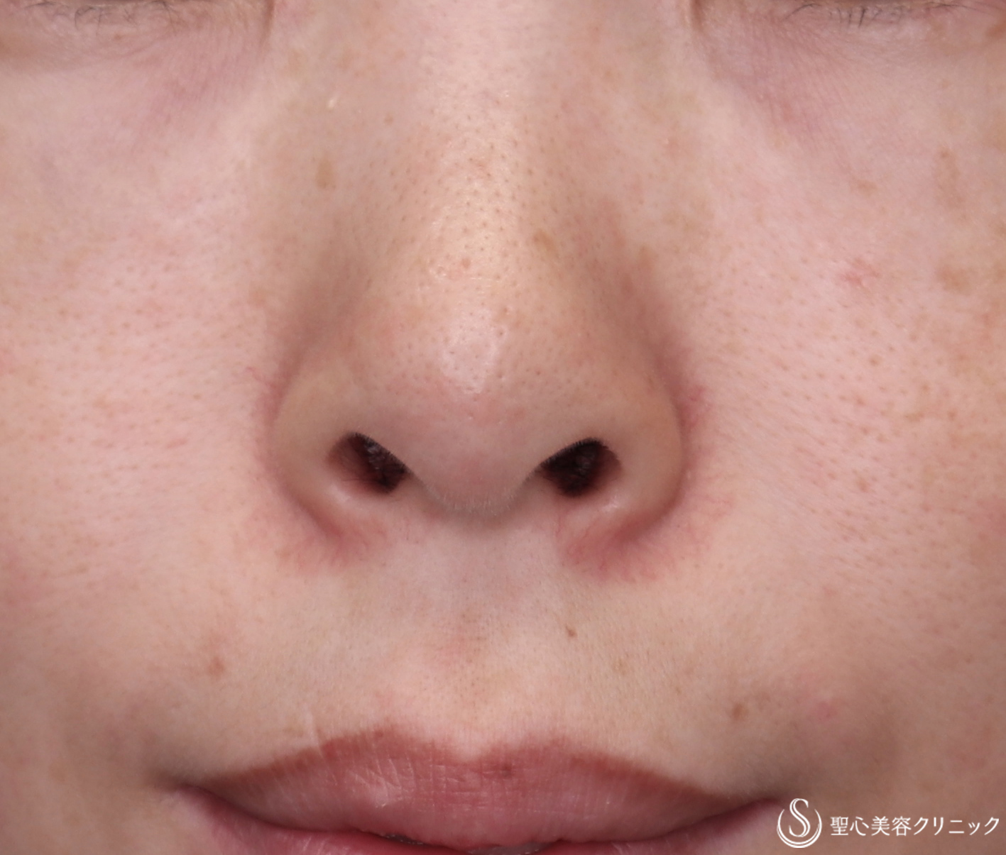【30代女性・鼻の穴を見えにくくする】鼻孔縁下降術（１ヶ月後） Before 