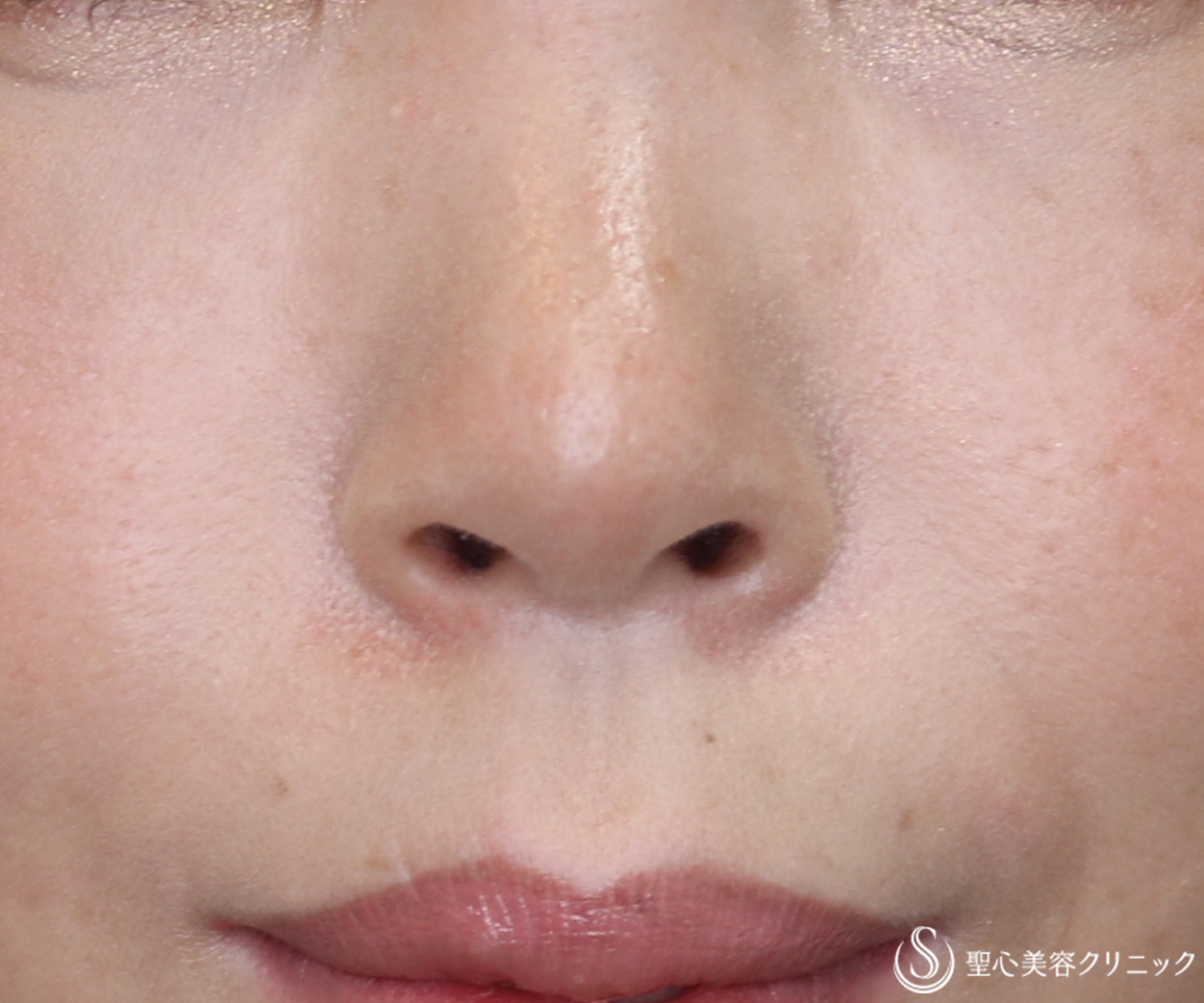 【30代女性・鼻の穴を見えにくくする】鼻孔縁下降術（１ヶ月後） After 