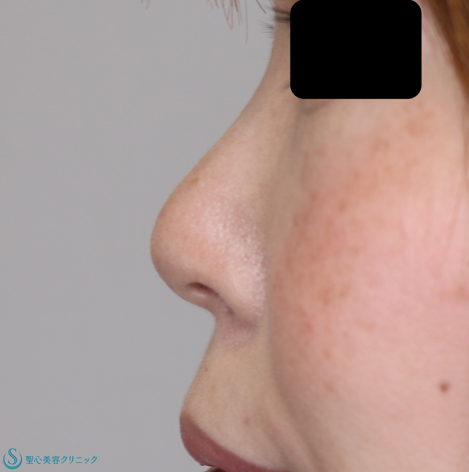 【30代女性・鼻先をすっきりと高く 】鼻尖縮小+鼻尖形成（耳介軟骨移植）（１ヶ月後） After 