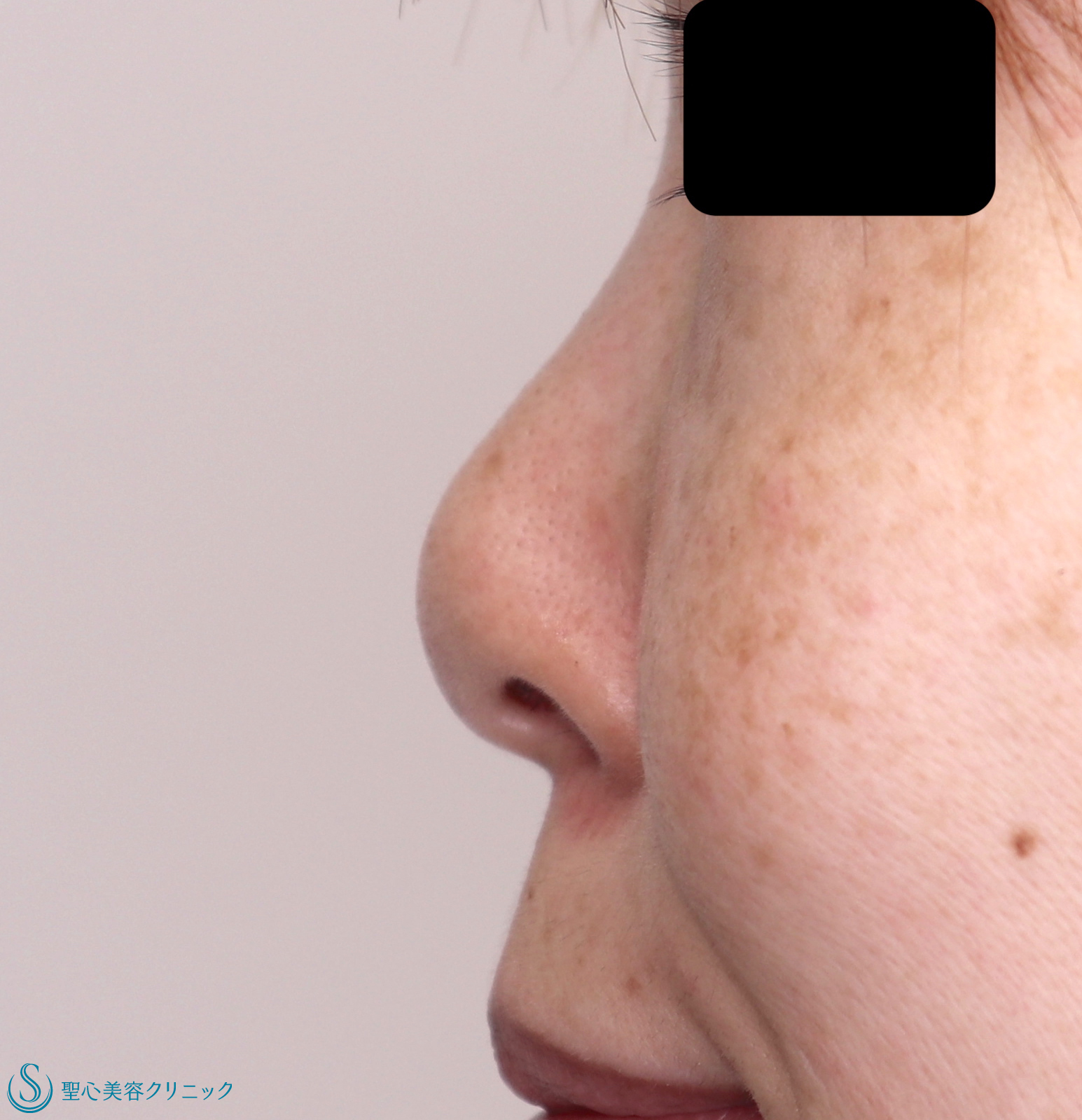 【30代女性・鼻先をすっきりと高く 】鼻尖縮小+鼻尖形成（耳介軟骨移植）（１ヶ月後） Before 