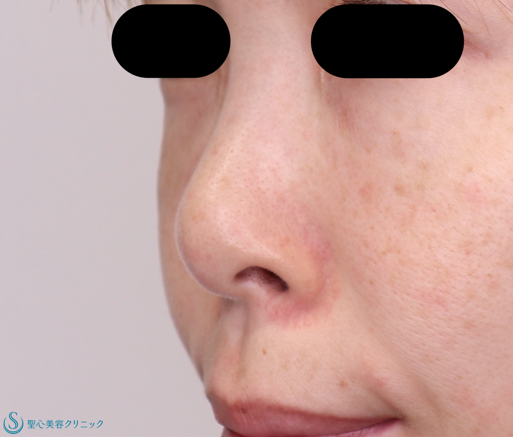 【30代女性・鼻先をすっきりと高く 】鼻尖縮小+鼻尖形成（耳介軟骨移植）（１ヶ月後） Before 