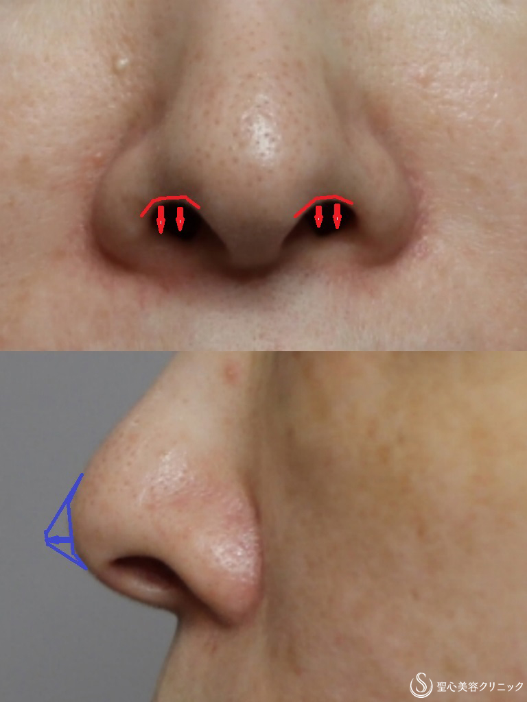 【50代女性・鼻の穴を目立ちにくく、鼻先を綺麗に】鼻孔縁下降術+鼻先耳介軟骨移植(1か月後） Before 