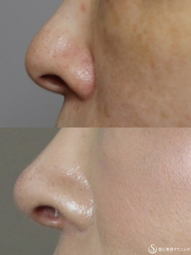 【50代女性・鼻の穴を目立ちにくく、鼻先を綺麗に】鼻孔縁下降術+鼻先耳介軟骨移植(1か月後） After 