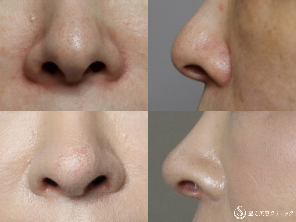 【50代女性・鼻の穴を目立ちにくく、鼻先を綺麗に】鼻孔縁下降術+鼻先耳介軟骨移植(1か月後） After 