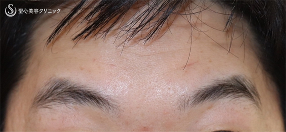 【40代男性・お顔のシワを全体的に綺麗に】プレミアムPRP皮膚再生療法（６ヶ月後） After 