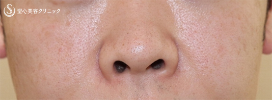 【40代男性・お顔のシワを全体的に綺麗に】プレミアムPRP皮膚再生療法（６ヶ月後） After 