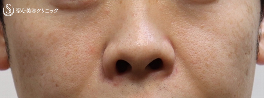 【40代男性・お顔のシワを全体的に綺麗に】プレミアムPRP皮膚再生療法（６ヶ月後） Before 