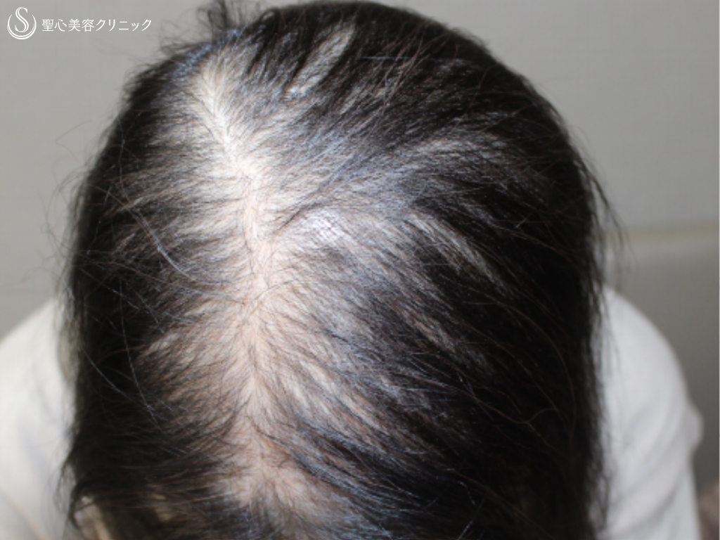 【50代女性・広範囲の薄毛を改善】毛髪複合治療（11ヶ月後） Before 