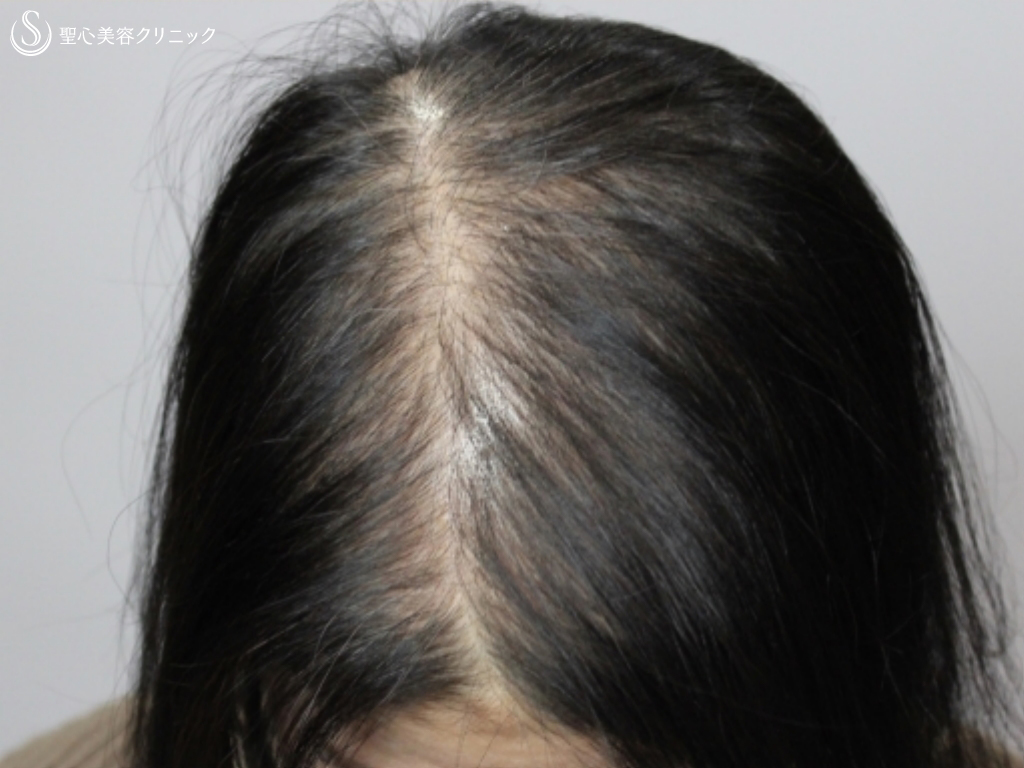 【50代女性・広範囲の薄毛を改善】毛髪複合治療（11ヶ月後） 症例写真 美容整形、美容外科なら聖心美容クリニック