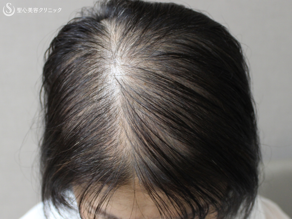 【50代女性・広範囲の薄毛を改善】毛髪複合治療（11ヶ月後） After 