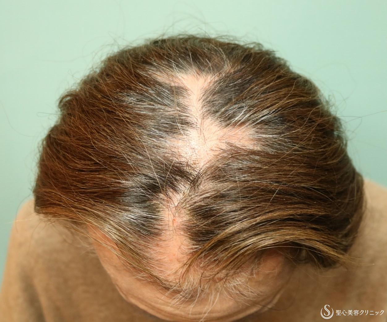 【50代女性・薄毛治療で髪質も改善】パントガール（2年後） 症例写真 美容整形、美容外科なら聖心美容クリニック