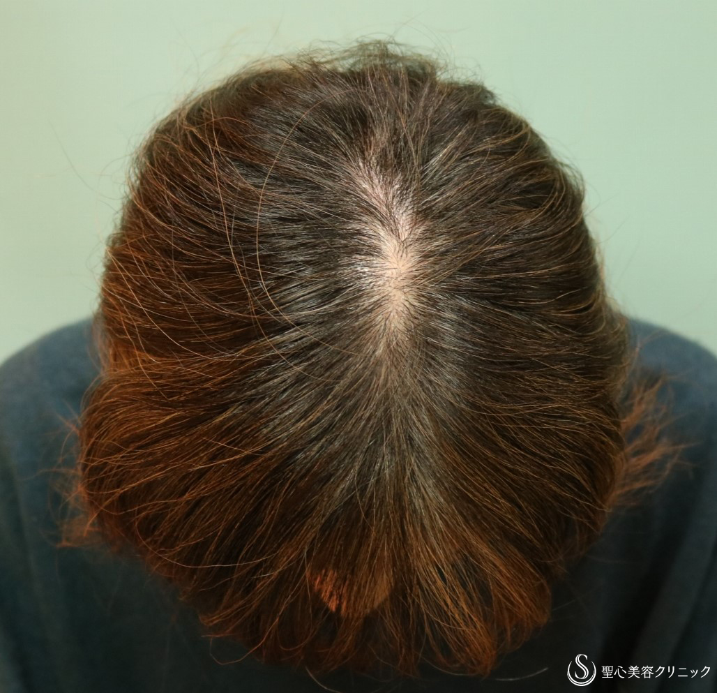 【50代女性・薄毛治療で髪質も改善】パントガール（2年後） 症例写真 美容整形、美容外科なら聖心美容クリニック