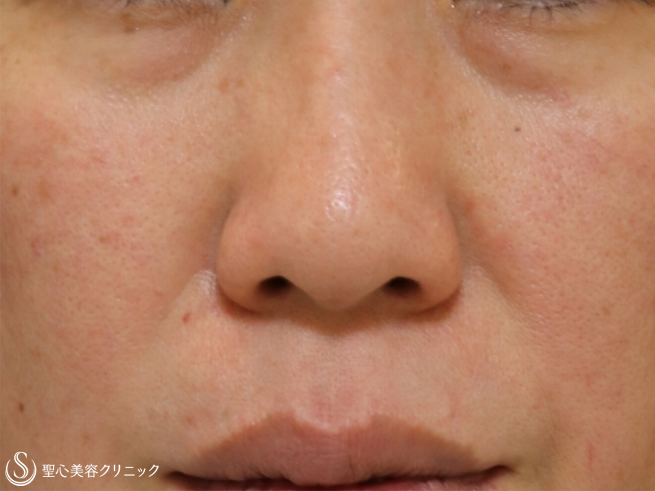 【40代女性・目の下とほうれい線】プレミアムPRP皮膚再生療法（1年後） Before 