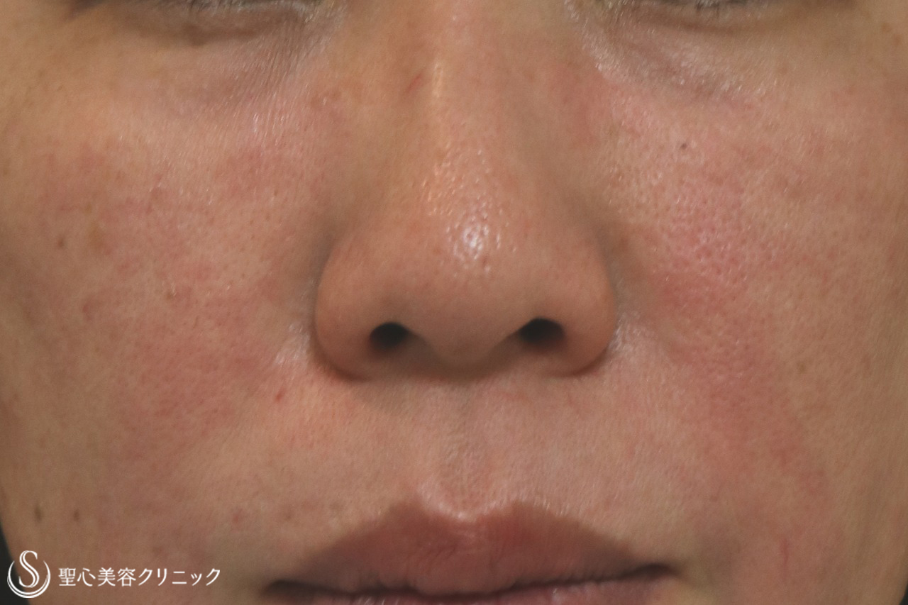 【40代女性・目の下とほうれい線】プレミアムPRP皮膚再生療法（1年後） After 