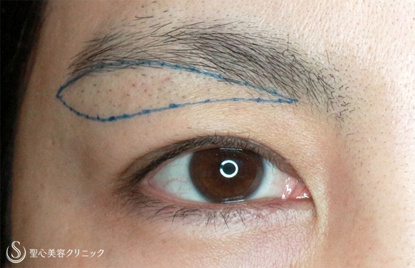 【40代女性・目の上のタルミ取り】眉下リフト長期経過（9年後） Before 