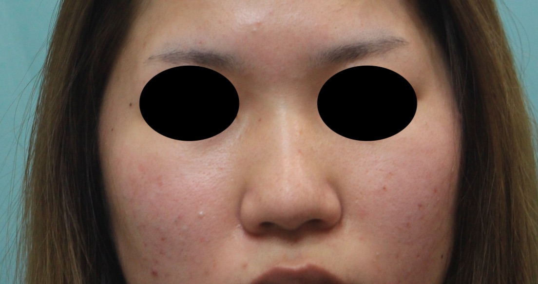 【20代女性・鼻筋をすっきり】プロテーゼによる隆鼻術+鼻尖形成（耳介軟骨移植）（1ヶ月後） Before 