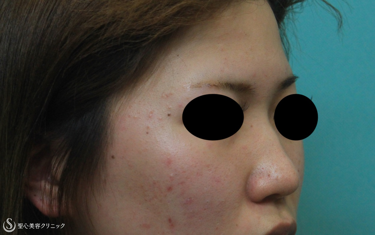 【20代女性・鼻筋をすっきり】プロテーゼによる隆鼻術+鼻尖形成（耳介軟骨移植）（1ヶ月後） Before 