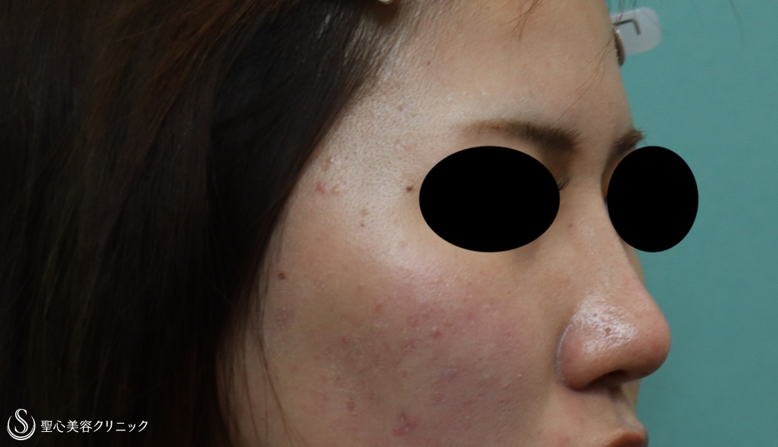 【20代女性・鼻筋をすっきり】プロテーゼによる隆鼻術+鼻尖形成（耳介軟骨移植）（1ヶ月後） After 