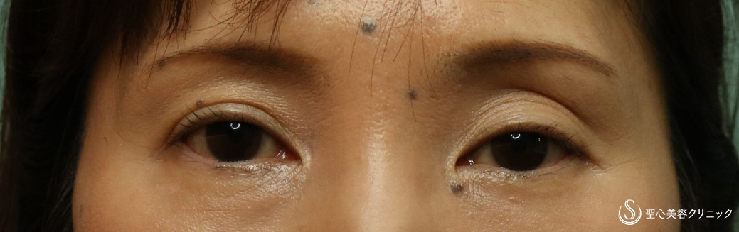 【40代女性・目の上のくぼみ】プレミアムPRP皮膚再生療法（2か月後） Before 